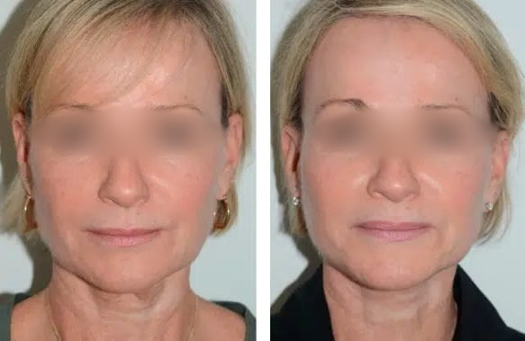 Lifting Facial y Cuello caso 5 — antes y después